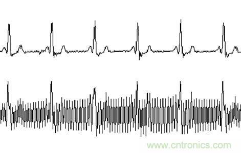 采用MSP430設計的12位心電(ECG)放大器 采用MSP430設計的12位心電(ECG)放大器